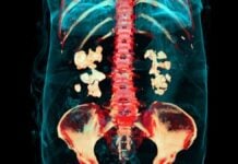 Бактерії, виявлені всередині звичайних ниркових каменів, кидають виклик Десятиліттям медичних уявлень