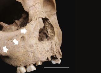 Ancient Teeth Reveal Syphilis-Like Disease Spread in Vietnam 4,000 Years Ago