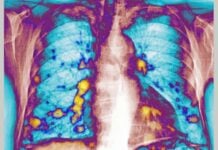 Вірусний захист: як респіраторні інфекції можуть блокувати метастази раку