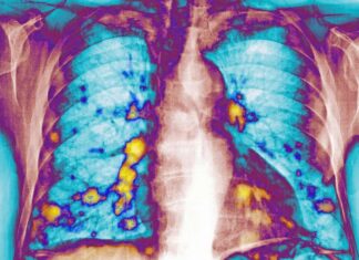 Defesa viral: como as infecções respiratórias podem bloquear a metástase do câncer